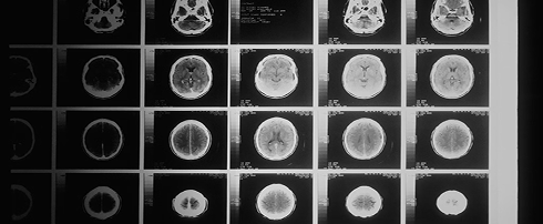 AI-powered medical image segmentation analyzing brain MRI scans for accurate detection and diagnosis.
